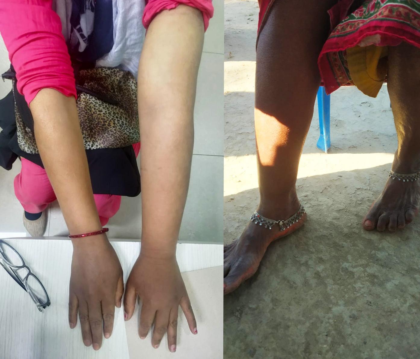 Lymphedema
